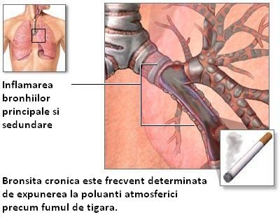 Bronsita cronica, emfizemul si obstructia cailor aeriene